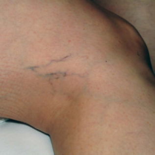 Laser Hair Removal Skin Tightening Acne Treatments Baton Rouge La Body Image Aesthetics